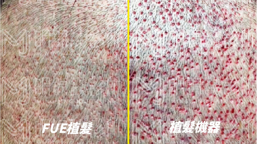 FUE與植髮機器人取髮孔徑大小比對