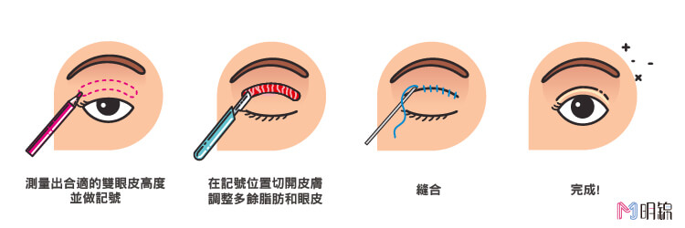 割雙眼皮步驟介紹